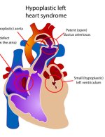 Diagram showing a healthy heart and one suffering from hypoplastic left heart syndrome